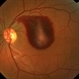 Preretinal Hemorrhage Preretinal Hemorrhage